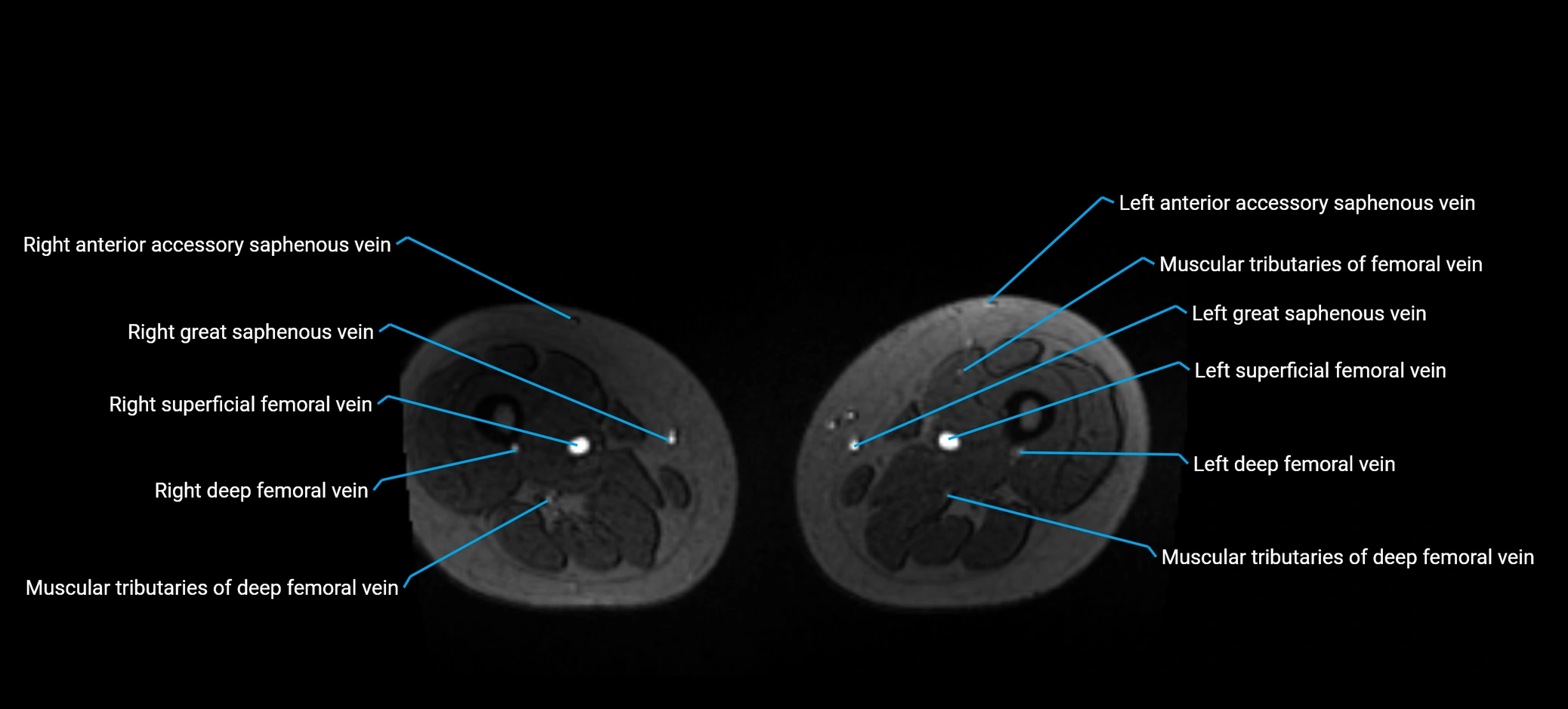 MRV abdomen pelvis & lower limb axial cross sectional anatomy labelled MRI image 287 (1).webp